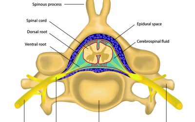 Epidural infiltrations for treating back pain